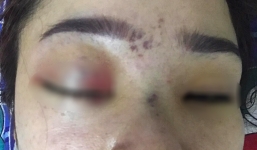 Hé lộ bất ngờ về chủ spa nâng mũi khiến cô gái bị mù vĩnh viễn