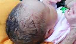 Nghệ An: Bé trai sinh mổ bị dao rạch trúng đầu phải khâu 6 mũi