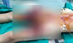 Học làm pháo trên mạng, nam sinh bị mất bàn tay phải, dập 2 bên đùi 