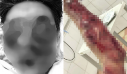 Mua pháo tự chế về chơi Tết, người đàn ông bị dập nát khuôn mặt và cánh tay