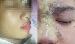 Thiếu nữ 15 tuổi mù mắt vĩnh viễn vì bị tiêm filler nhầm vào mạch máu khi đi nâng mũi