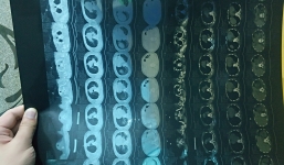 Dịch virus Corona: nCoV đang biến đổi và có dấu hiệu rất đáng lo ngại