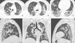 3 dấu hiệu cho thấy phổi bệnh nhân mắc Covid-19 bị tổn thương