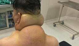 Nghiện rượu nhiều năm, người đàn ông bị biến dạng cơ thể