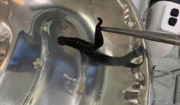 Hay tắm suối, thiếu nữ 14 tuổi bị đỉa dài gần 10cm chui vào mũi