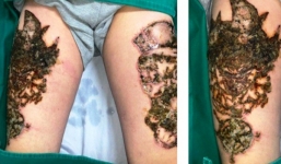 Xóa xăm bằng đốt điện hoặc laser CO2, thanh niên bị tổn thương 2 đùi