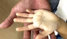 Hình ảnh bàn tay trắng toát của bé gái cảnh tỉnh các bậc phụ huynh