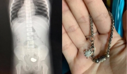 Bé gái 3 tuổi nuốt chiếc vòng trang sức vào bụng khiến cả nhà hốt hoảng