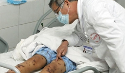 Một phụ nữ nhiễm liên cầu lợn chưa rõ nguồn lây, từng ăn nem chua trước khi khởi bệnh