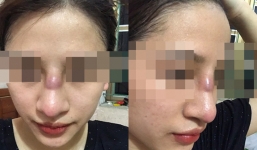 Tin tưởng đến spa để nâng mũi, cô gái bị phẫu thuật hỏng đến 4 lần phải cầu cứu bác sĩ