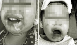 Cắn dây điện khi ngồi đùa nghịch, bé gái 2 tuổi bị hoại tử vùng miệng