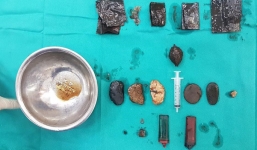 Mắc bệnh lạ, người đàn ông nuốt tất cả dao lam, bật lửa, hòn sỏi, túi nilon vào bụng