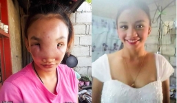 Nặn mụn trứng cá ở mũi, cô gái trẻ mắc bệnh lạ đến chồng con cũng nhận không ra