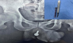 Nhậu say, 'thần cồn' bị bạn cùng bàn nhét chiếc vít dài 6cm vào đường tiểu