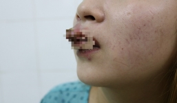 Đầu tư 2 triệu xăm môi đón Tết, cô gái phải đến bệnh viện cầu cứu bác sĩ