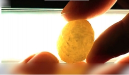 Sự thực thông tin phát hiện 'xá lợi Phật' trong cơ thể bệnh nhân