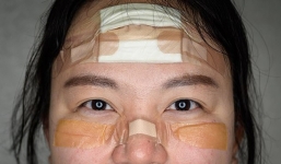 Xót xa hình ảnh nữ y tá loét mặt vì đeo khẩu trang