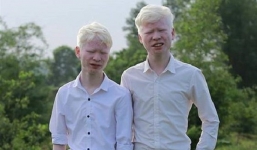 Cặp anh em sinh đôi bạch tạng đổi đời sau 7 năm nổi tiếng