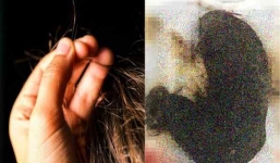 Bé gái 11 tuổi mang khối u dài cả gang tay chứa đầy tóc trong dạ dày 