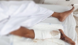 Hải Phòng: Người đàn ông suýt cưa chân vì thói quen ăn gỏi cá sống