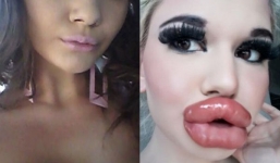 'Búp bê Barbie đời thực' phẫu thuật 20 lần để có đôi môi dày nhất thế giới