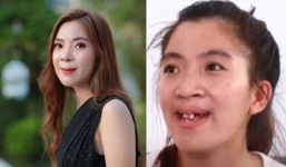 'Hotgirl không môi' một bước đổi đời, thoát kiếp miệt thị