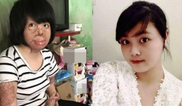 Thiếu nữ Hà Nội bị chồng nhẫn tâm tưới xăng thiêu sống đến biến dạng mặt giờ ra sao?