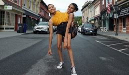 Cặp song sinh 19 năm dính liền, cãi nhau vẫn phải gắn bó