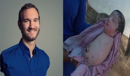 Gia đình khóc hết nước mắt khi sản phụ sinh ra bé gái khuyết tứ chi