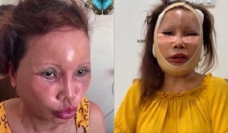 Cô dâu Thu Sao khiến dân mạng xót xa khi khoe mặt biến dạng hậu phẫu thuật