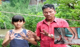 Chuyện lạ: Gia đình 3 thế hệ đều có 24 ngón tay, chân