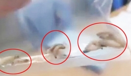 Moi được 40 con giòi đang lúc nhúc trong tai người đàn ông Quảng Nam 