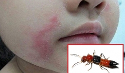 3 bước chữa kiến ba khoang đốt nhanh khỏi nhất ngay tại nhà