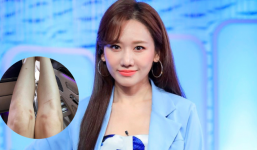 Chi bội tiền đi thẩm mỹ nhưng Hari Won thừa nhận không thể chữa được khuyết điểm này trên cơ thể