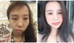 Từng bị trêu chọc vì gương mặt khác người, cô nàng 'vượt hạng' nhan sắc thành hotgirl hậu can thiệp thẩm mỹ