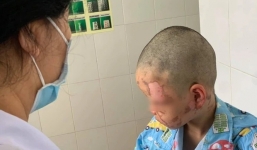 Bé trai 10 tuổi bỏng nặng do cồn sau khi học theo clip trên mạng