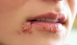 Cách chữa bệnh 'giời leo' cực nhanh và hiệu quả