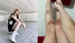 Thiều Bảo Trâm – bạn gái tin đồn Sơn Tùng MTP đăng ảnh tay chân bầm tím, viết tâm thư cho fan