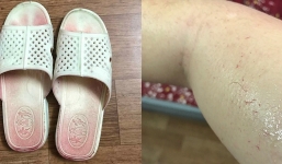 Người Việt đầu tiên phát hiện mắc chứng ‘mồ hôi máu’ siêu hiếm gặp