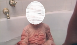 Bé trai sinh ra toàn thân nhăn nheo đáng sợ, gây sốc cả thế giới giờ ra sao?