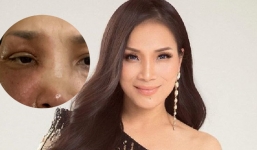 Cuộc sống của nữ ca sĩ từng bỏng 2/3 khuôn mặt gây sốc giờ ra sao?