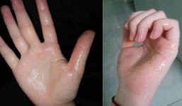 Mẹo nhận biết bệnh bản thân mắc phải chỉ bằng cách nắm bàn tay trong 3 giây