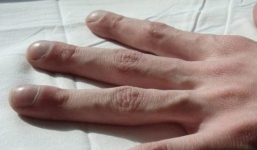 Bạn cần đi khám gan ngay nếu có 3 biểu hiện này trên đôi bàn tay