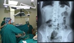 Thanh niên 17 tuổi có trái tim bên phải, phủ tạng ngược so với người bình thường