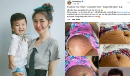 Hoà Minzy đăng tải bụng bầu bé Bo ‘chằng chịt’ thâm đen, ai làm mẹ mới hiểu sự hi sinh này