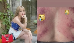 Thiều Bảo Trâm lộ cơ thể chi chít vết bầm hậu lùm xùm 'trà xanh sinh con cho sếp'