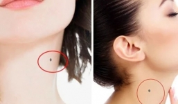 2 vị trí nốt ruồi vùng cổ kéo tài lộc, 1 nốt ruồi phá tướng cẩn trọng tai ương