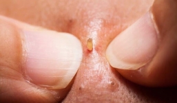 Vì sao ai ai cũng ‘mê mệt’ clip nặn mụn dẫu chúng rất... nổi da gà?