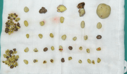 Phú Thọ: Gắp hơn 100 viên sỏi trong thận của nam bệnh nhân 62 tuổi