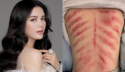 Lý Nhã Kỳ khoe tấm lưng đỏ ửng, hé lộ tình hình sức khỏe khiến fan xót xa